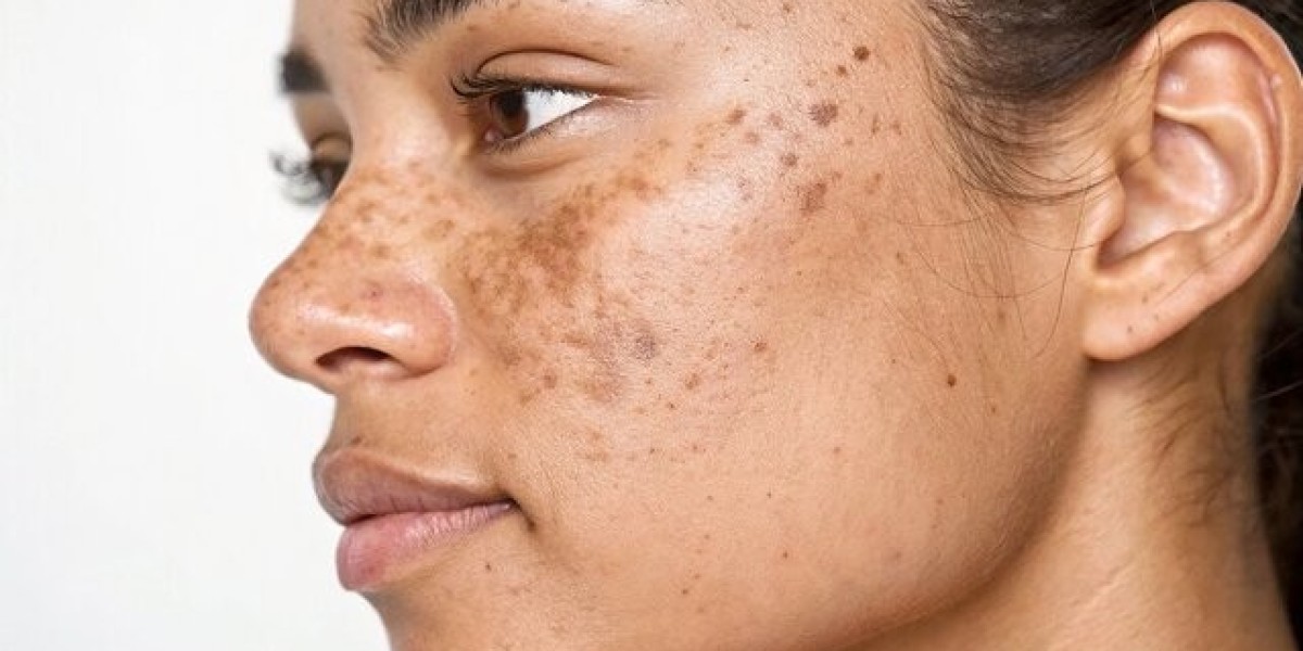 Dark Spot Correction Chevy Chase | Spa Chevy Chase